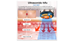 Hifu 3.0 Radiofrecuancia Facial Portátil Ems - Imagen 2